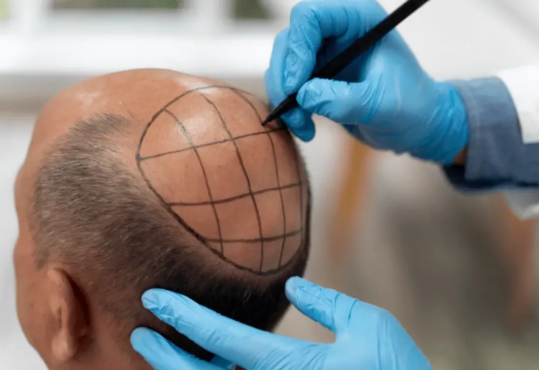 Hair Restoration
